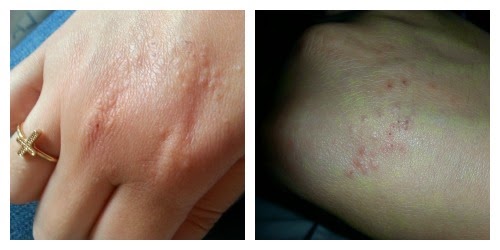Dermatite di atopic delle dita di mani a bambini